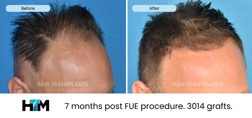 18.3 - 325418 - 7 months post FUE procedure. 3014 grafts