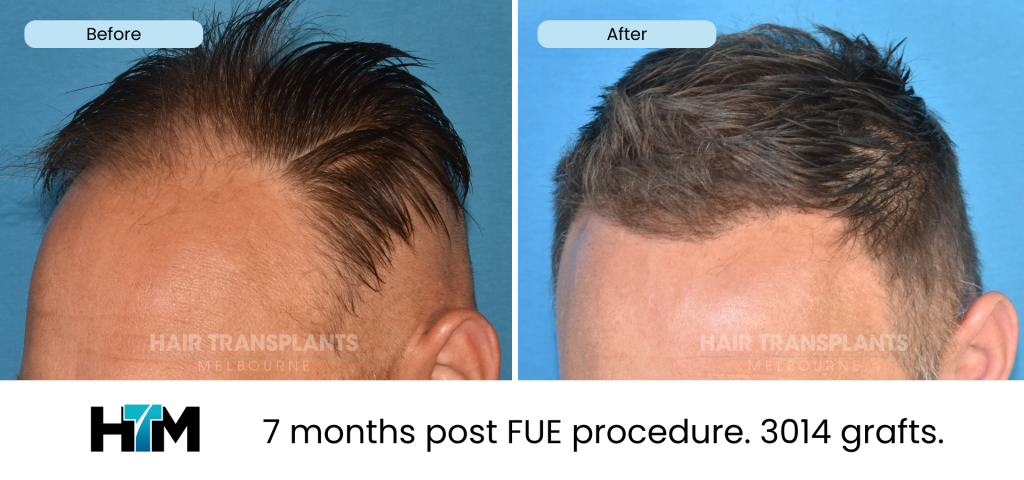 18.4 - 325418 - 7 months post FUE procedure. 3014 grafts