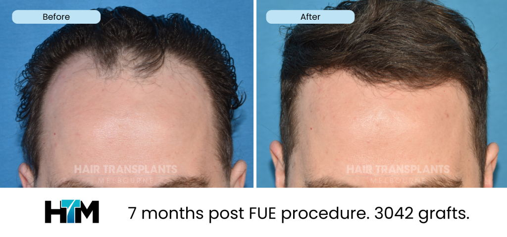 19.1 - 309985 - 7 months post FUE procedure. 3042 grafts