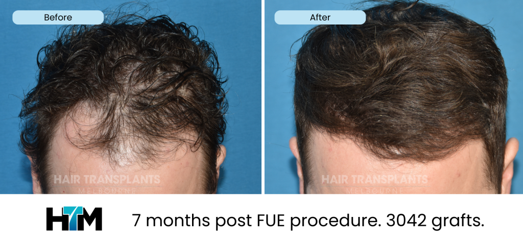 19.2 - 309985 - 7 months post FUE procedure. 3042 grafts
