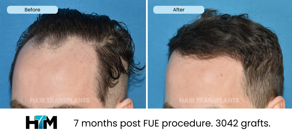 19.3 - 309985 - 7 months post FUE procedure. 3042 grafts