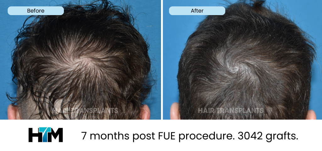 19.4 - 309985 - 7 months post FUE procedure. 3042 grafts