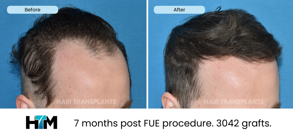 19.5 - 309985 - 7 months post FUE procedure. 3042 grafts