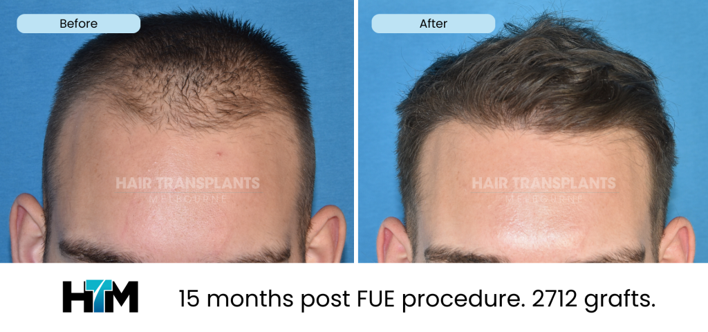 33 1 314203 2712 FUE 15 months