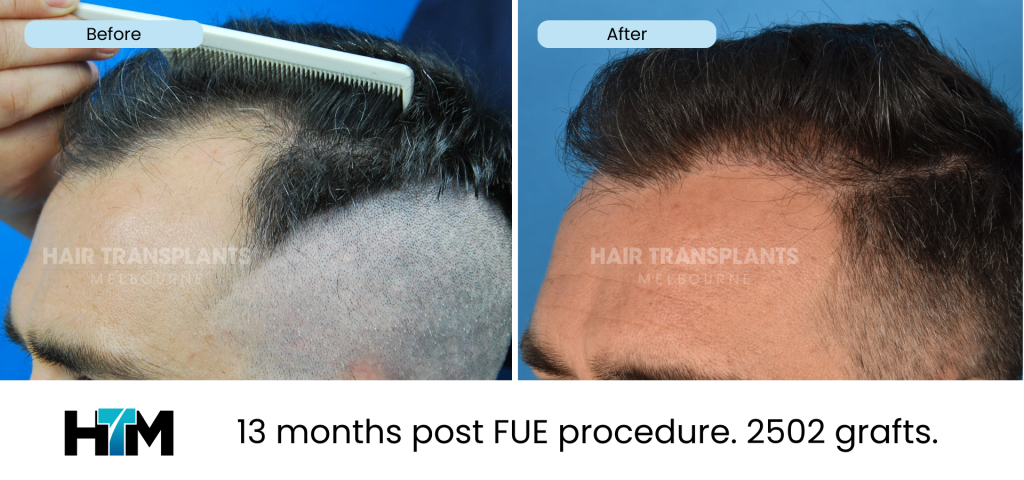4.1 - 13 months post FUE procedure. 2502 grafts