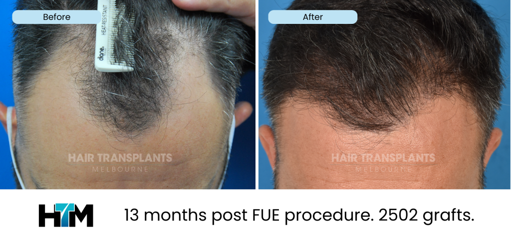 4.2 - 13 months post FUE procedure. FUE 2502 grafts