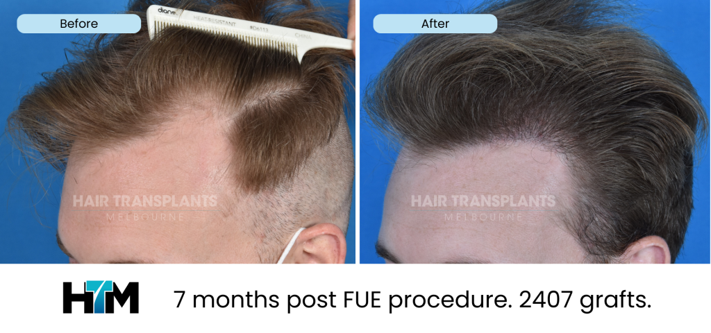 6.1 - 7 months post FUE procedure. 2407 grafts