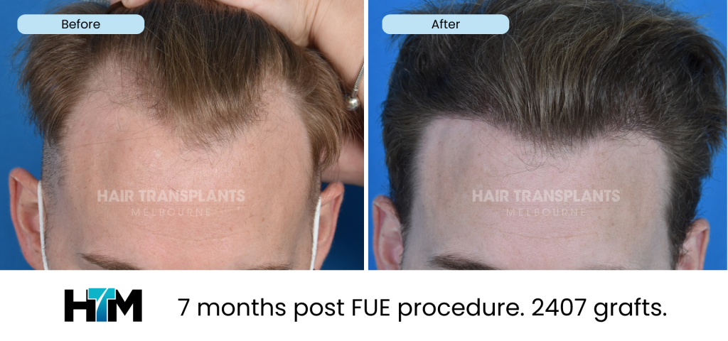 6.2 - 7 months post FUE procedure. 2407 grafts
