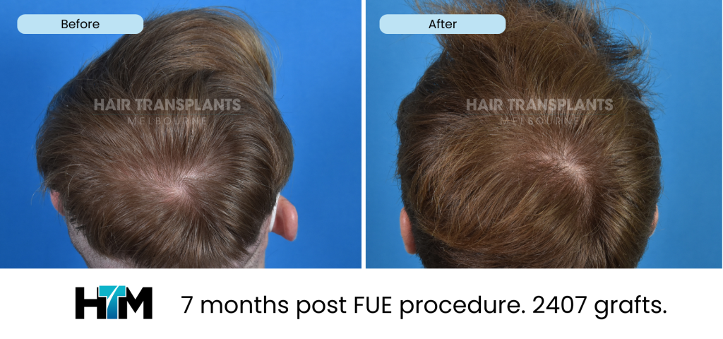 6.3 - 7 months post FUE procedure. 2407 grafts