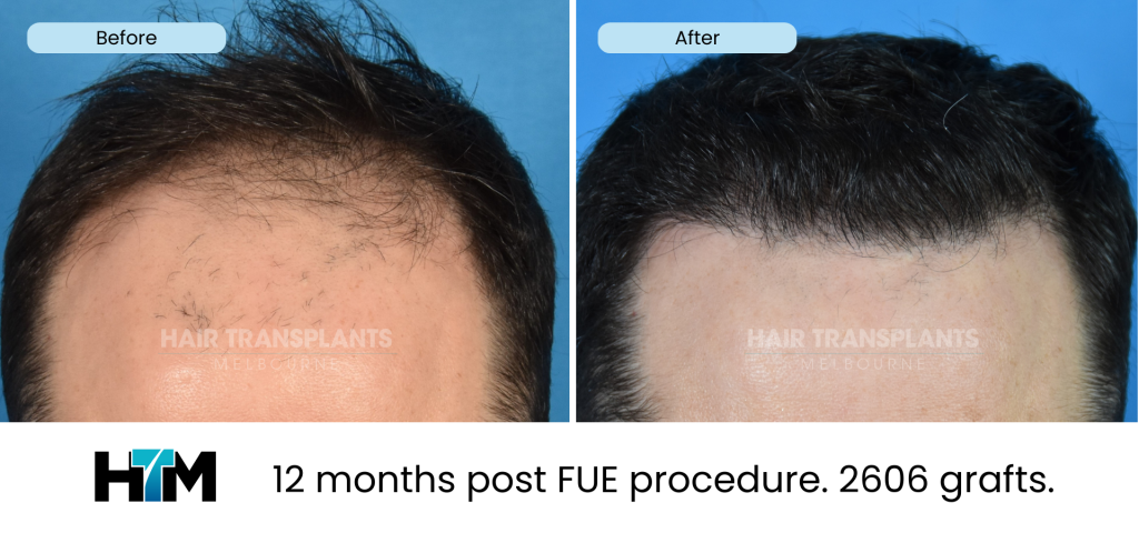 7.1 - 12 months post FUE procedure. 2606 grafts