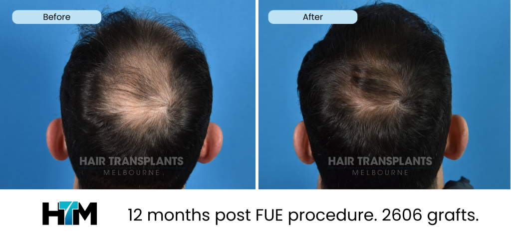 7.2 - 12 months post FUE procedure. 2606 grafts
