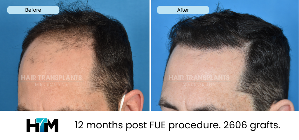 7.3 - 12 months post FUE procedure. 2606 grafts