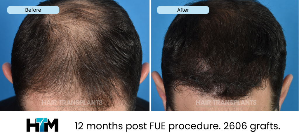 7.4 - 12 months post FUE procedure. 2606 grafts