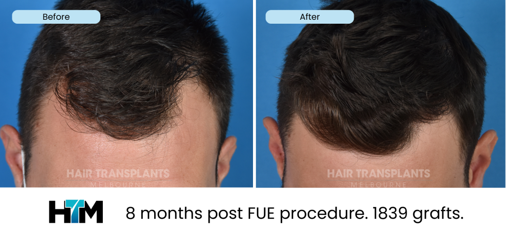 8.1 - 8 months post FUE procedure. 1839 grafts