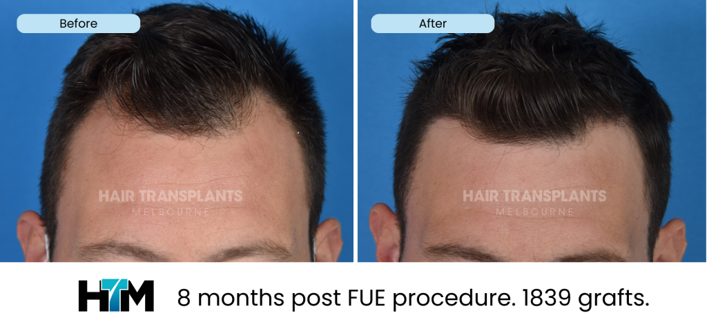 8.2 - 8 months post FUE procedure. 1839 grafts