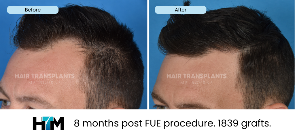 8.3 - 8 months post FUE procedure. 1839 grafts
