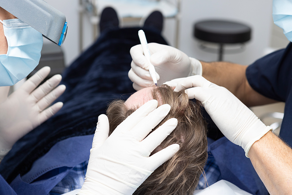 Can a Hair Transplant Permanently Restore Your Hair?