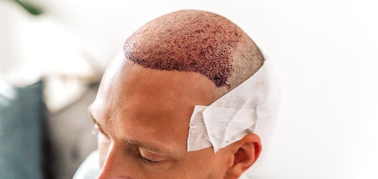 Hair Transplant Post Op Recovery Guide & Advice From Doctor-Led Clinic | FUE & FUT Hair Transplantation For Men & Women | Hair Transplants Melbourne