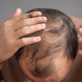 Does Creatine Cause Baldness & Hair Loss In Men Or Women | Creatine Side Effects | Hair Loss Myths | Hair Growth Clinic | Hair Transplants Melbourne