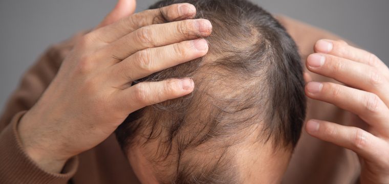 Does Creatine Cause Baldness & Hair Loss In Men Or Women | Creatine Side Effects | Hair Loss Myths | Hair Growth Clinic | Hair Transplants Melbourne