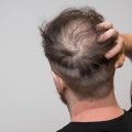 Signs & Symptoms Of Balding | Male Pattern Hair Loss | Androgenetic Alopecia | Hair Loss Treatments | Hair Transplants Melbourne