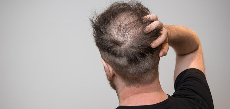 Signs & Symptoms Of Balding | Male Pattern Hair Loss | Androgenetic Alopecia | Hair Loss Treatments | Hair Transplants Melbourne