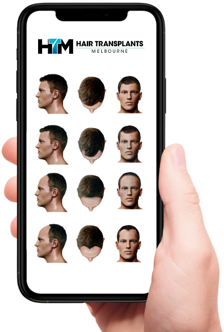 TAKE OUR QUICK HAIR LOSS QUIZ